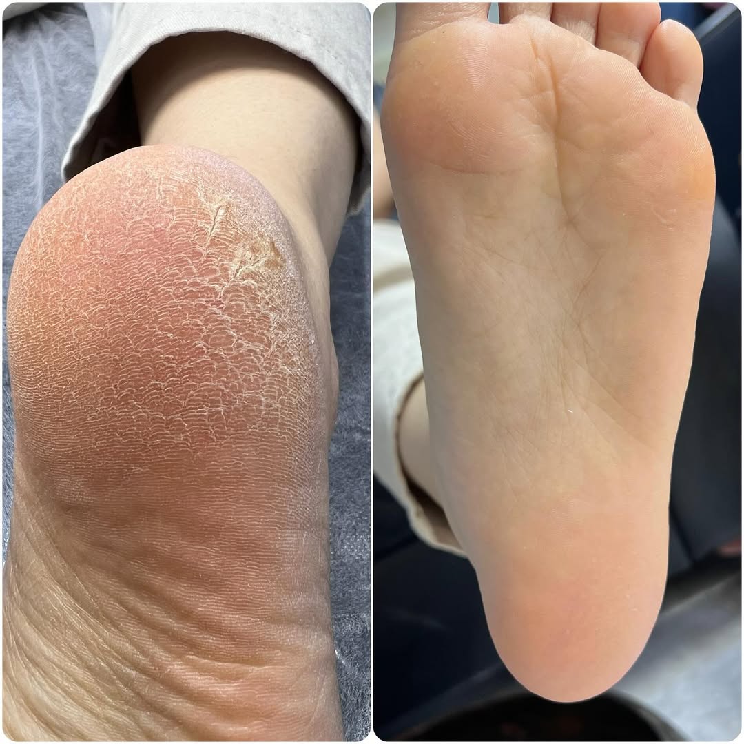 قبل و بعد پدیکور درمانی

#ترک_پاشنه_پا #آموزش_پدیکور #پدیکور - Download Instagram Video