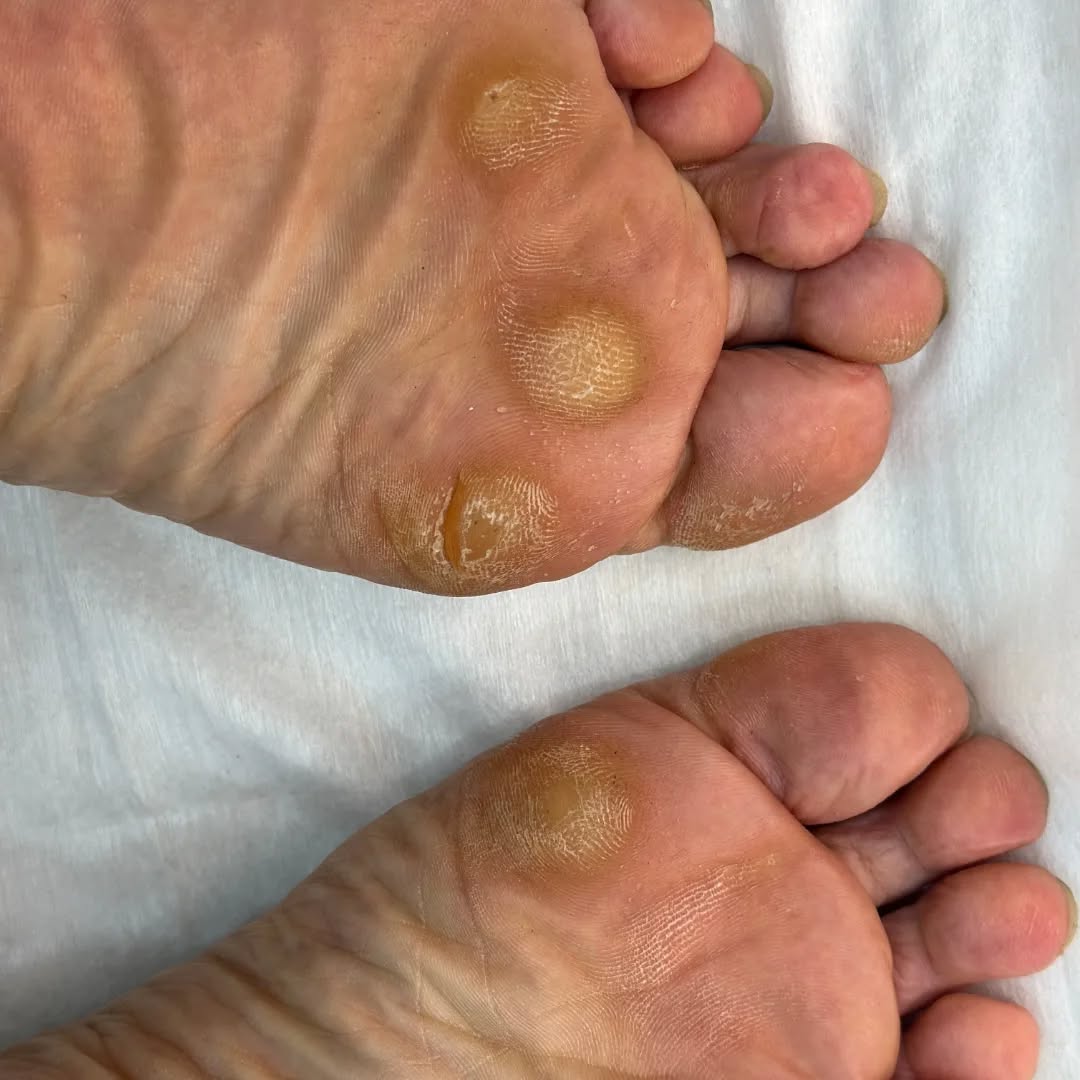 اسیب این پا که پینه های سکه ای و نقطعه ای به وجود اومده روی  - Download Instagram Video