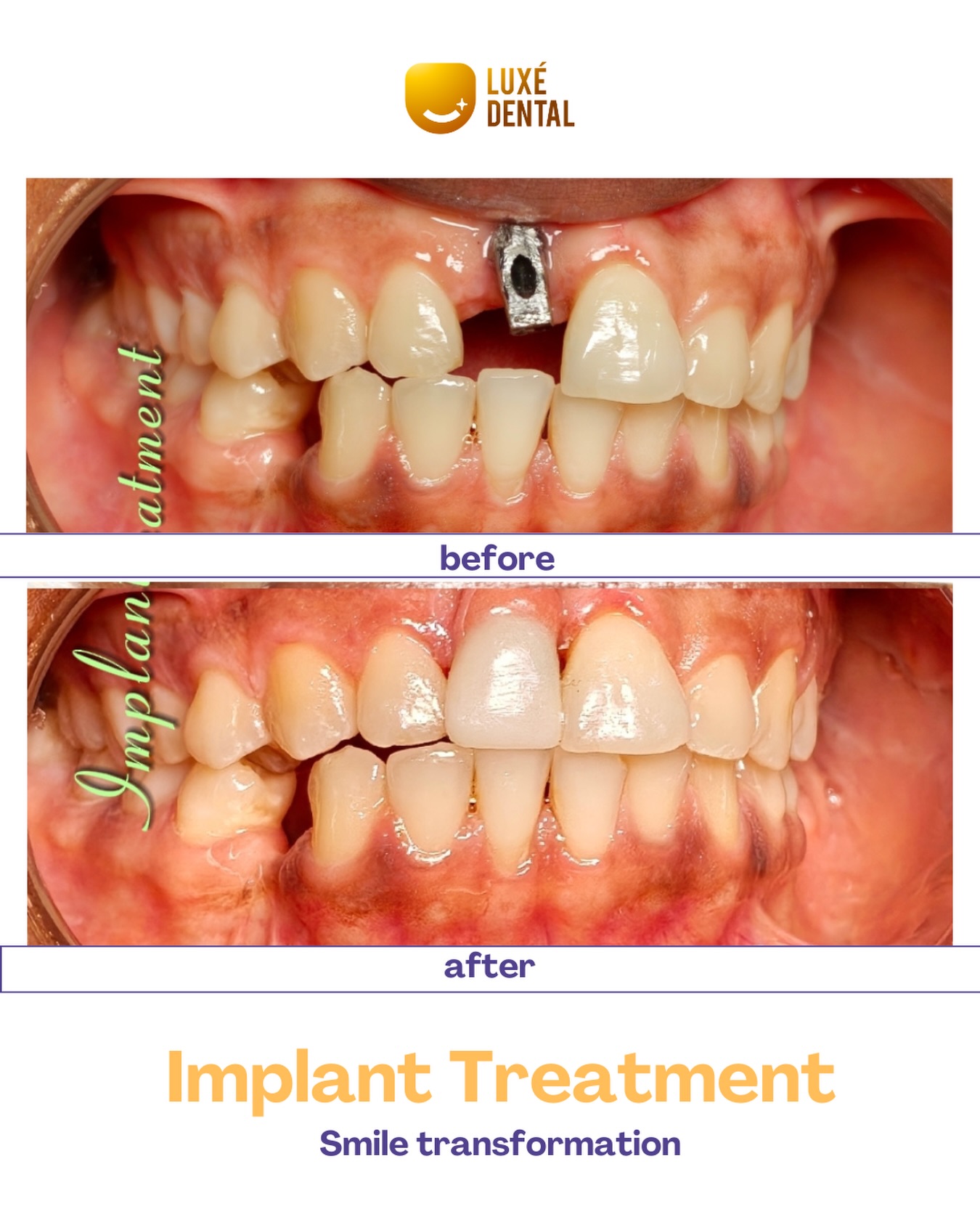 This implant treatment restored both function and aesthetics, giving our patient a…