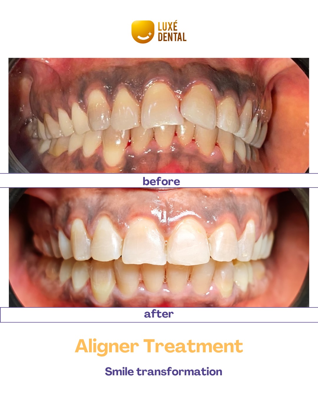 A confidence boost smile transformation 😍😍 To Schedule an appointment, 📲Send a…